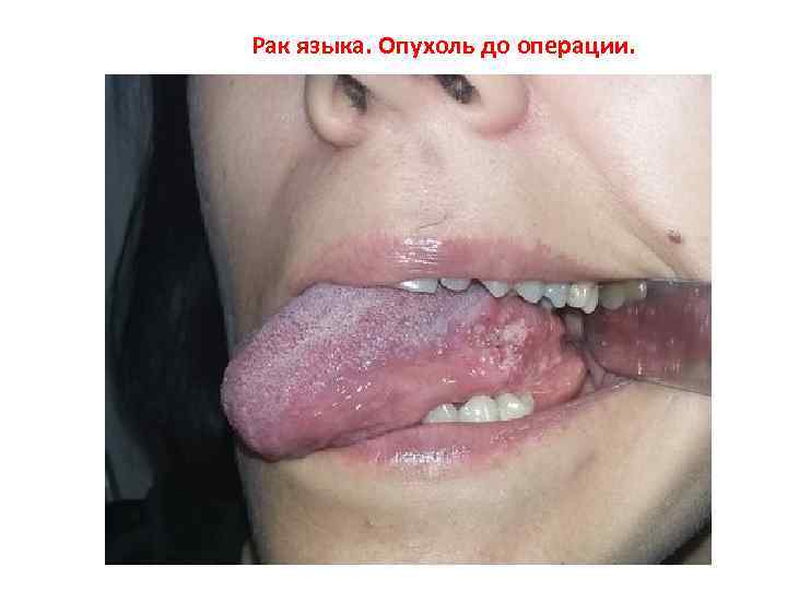 Рак языка. Опухоль до операции. 