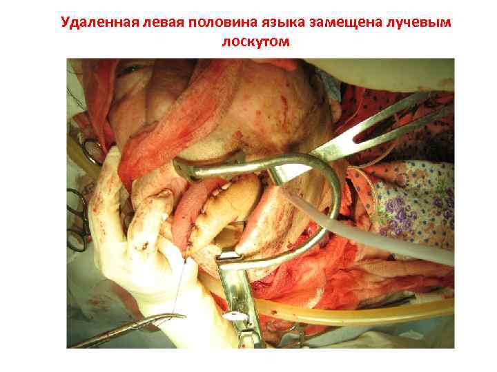 Удаленная левая половина языка замещена лучевым     лоскутом 