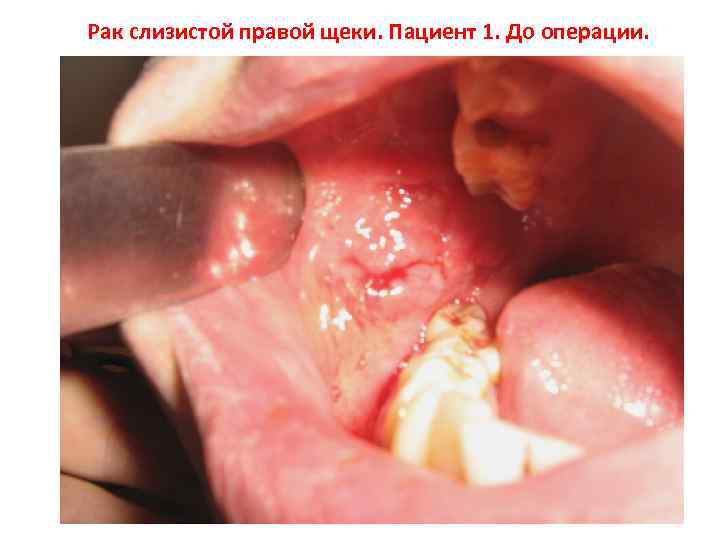 Рак слизистой правой щеки. Пациент 1. До операции. 