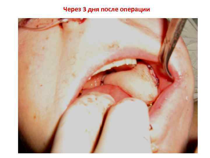 Через 3 дня после операции 