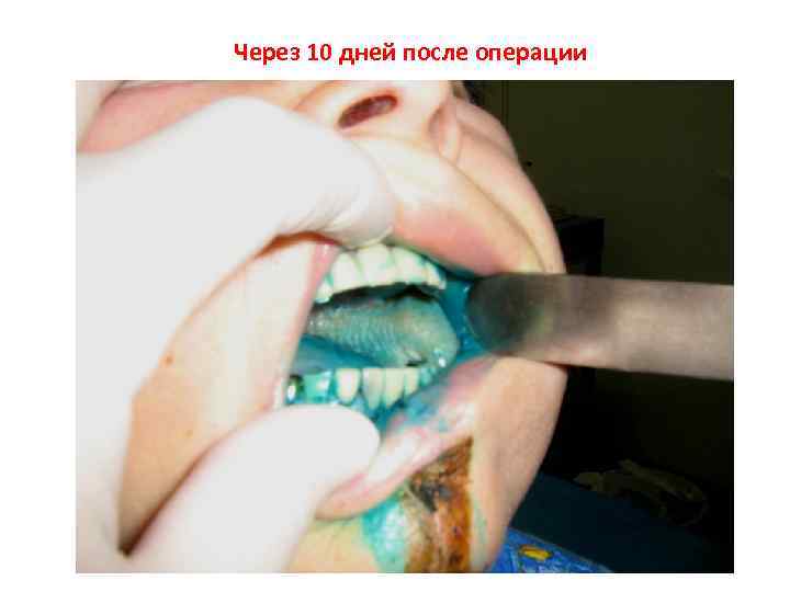 Через 10 дней после операции 