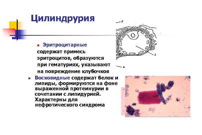   Цилиндрурия  n Эритроцитарные  содержат примесь эритроцитов, образуются при гематуриях, указывают