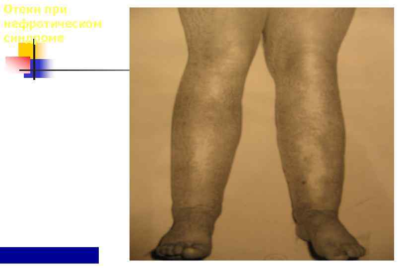 Отеки при нефротическом синдроме 