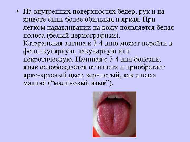  • На внутренних поверхностях бедер, рук и на  животе сыпь более обильная