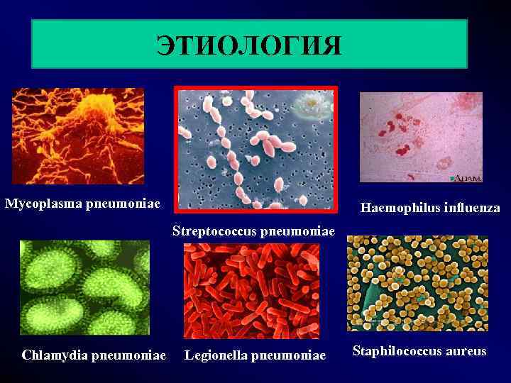     ЭТИОЛОГИЯ Mycoplasma pneumoniae      Haemophilus influenza