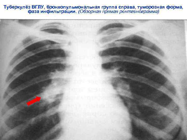 Туберкулёз ВГЛУ, бронхопульмональная группа справа, туморозная форма,  фаза инфильтрации. (Обзорная прямая рентгенограмма) 