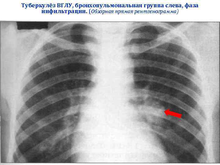 Туберкулёз ВГЛУ, бронхопульмональная группа слева, фаза  инфильтрации. (Обзорная прямая рентгенограмма) 