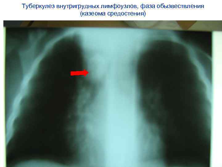 Туберкулез внутригрудных лимфоузлов, фаза обызвествления    (казеома средостения) 