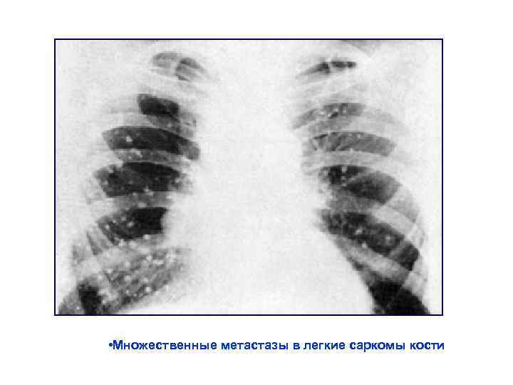  • Множественные метастазы в легкие саркомы кости 