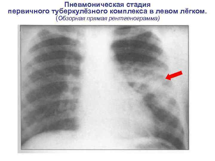     Пневмоническая стадия первичного туберкулёзного комплекса в левом лёгком.  