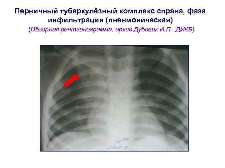 Первичный туберкулёзный комплекс справа, фаза  инфильтрации (пневмоническая)  (Обзорная рентгенограмма, архив Дубовик И.