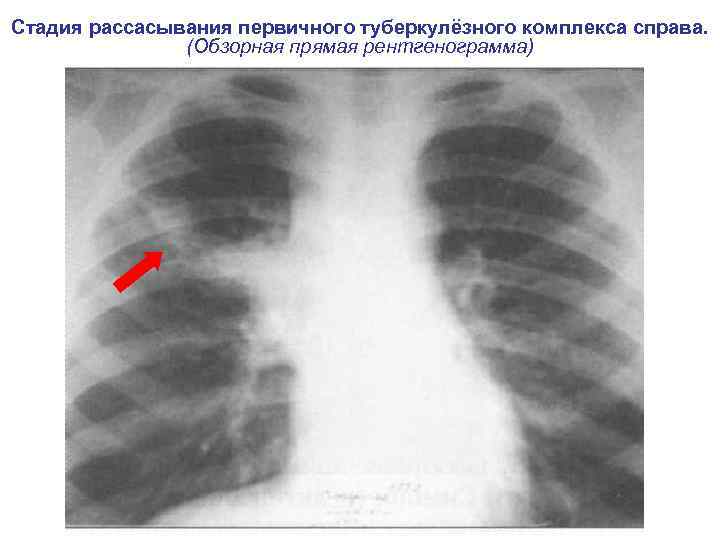 Стадия рассасывания первичного туберкулёзного комплекса справа.   (Обзорная прямая рентгенограмма) 