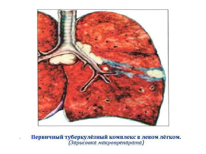 .  Первичный туберкулёзный комплекс в левом лёгком.   (Зарисовка макропрепарата) 
