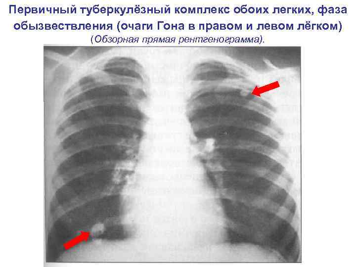 Первичный туберкулёзный комплекс обоих легких, фаза обызвествления (очаги Гона в правом и левом лёгком)