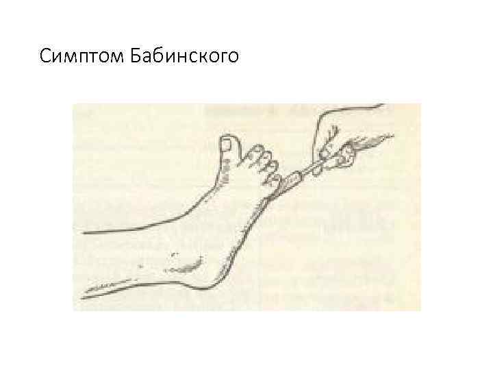 Симптом Бабинского 