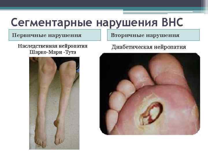 Сегментарные нарушения ВНС Первичные нарушения   Вторичные нарушения Наследственная нейропатия  Диабетическая нейропатия