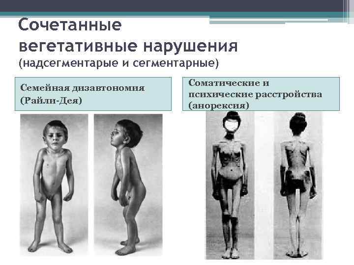 Сочетанные вегетативные нарушения (надсегментарые и сегментарные)      Соматические и Семейная