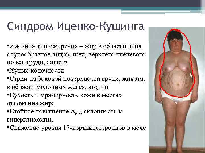 Синдром Иценко-Кушинга • «Бычий» тип ожирения – жир в области лица «лунообразное лицо» ,