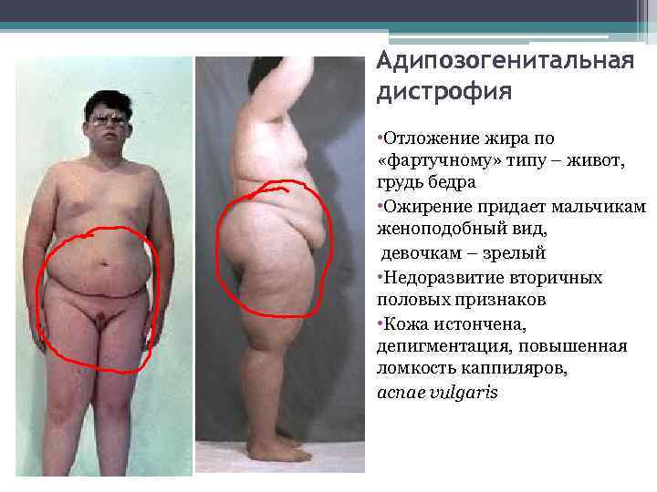Адипозогенитальная дистрофия • Отложение жира по «фартучному» типу – живот, грудь бедра • Ожирение