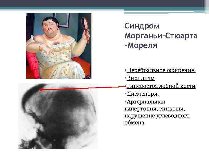 Синдром Морганьи-Стюарта -Мореля  • Церебральное ожирение,  • Вирилизм • Гиперостоз лобной кости