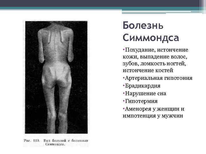 Болезнь Симмондса • Похудание, истончение кожи, выпадение волос, зубов, ломкость ногтей, истончение костей •