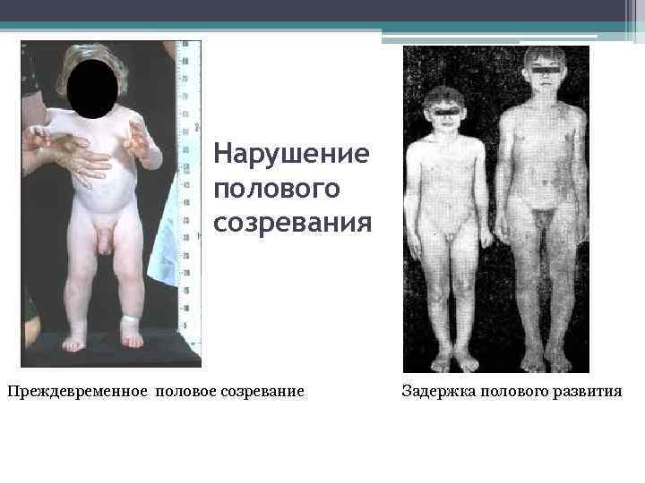     Нарушение    полового    созревания Преждевременное