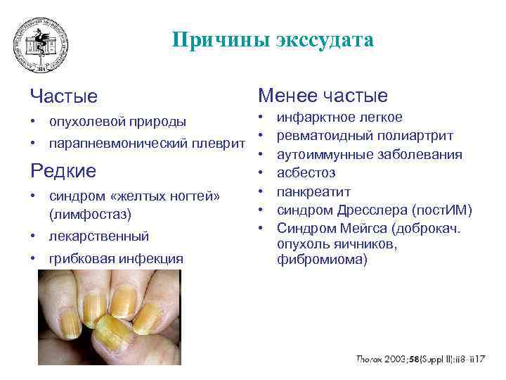 Причины экссудата Частые Менее частые • • • парапневмонический плеврит • Редкие • •