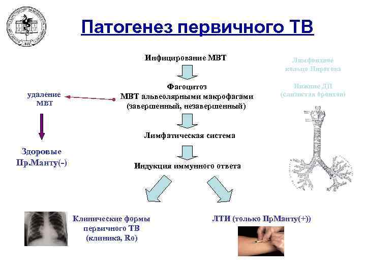 Патогенез первичного TB Инфицирование MBT удаление MBT Лимфоидное кольцо Пирогова Фагоцитоз MBT альвеолярными макрофагами