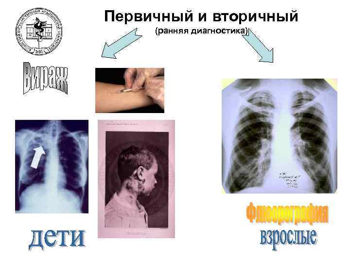Первичный и вторичный (ранняя диагностика) 