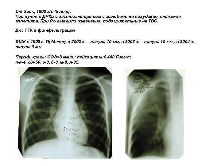 Б-й Зот. , 1996 г/р (8 лет). Поступил в ДРКБ с гастроэнтеритом с жалобами