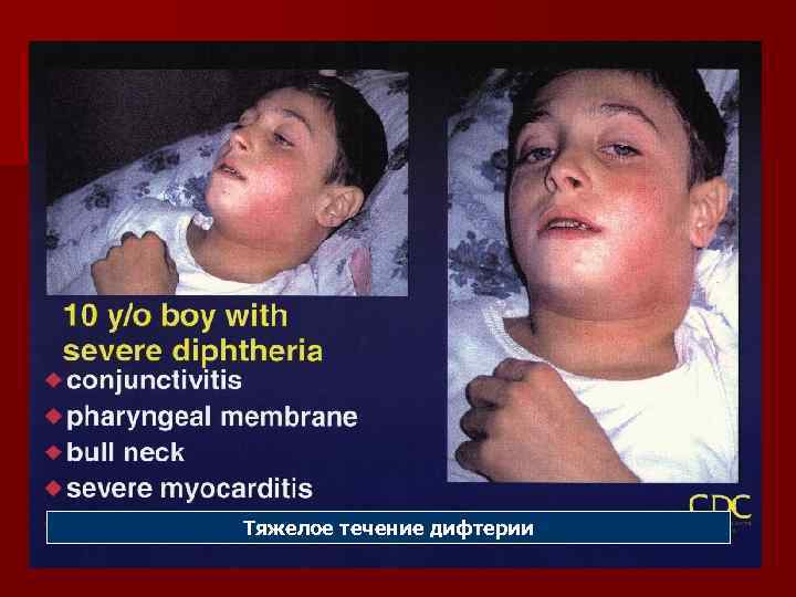 Тяжелое течение дифтерии 