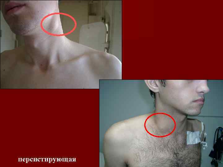 персистирующая 