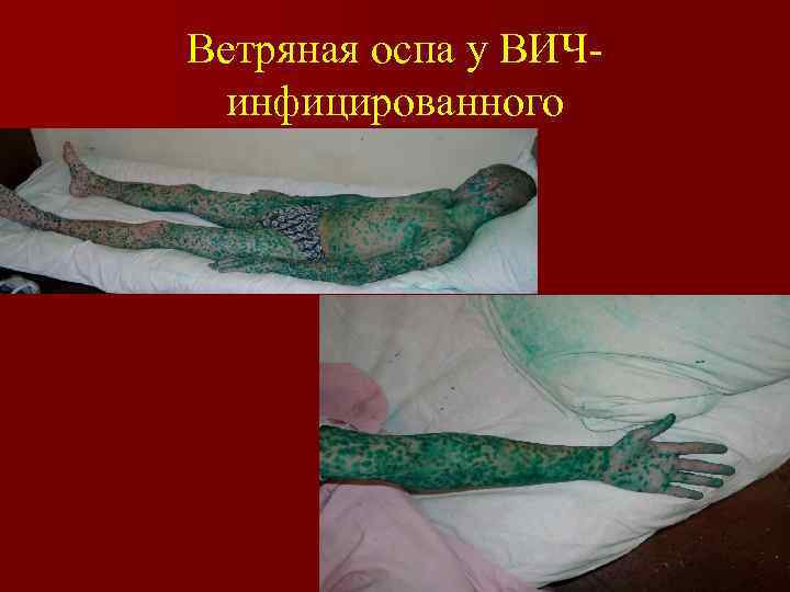Ветряная оспа у ВИЧинфицированного 