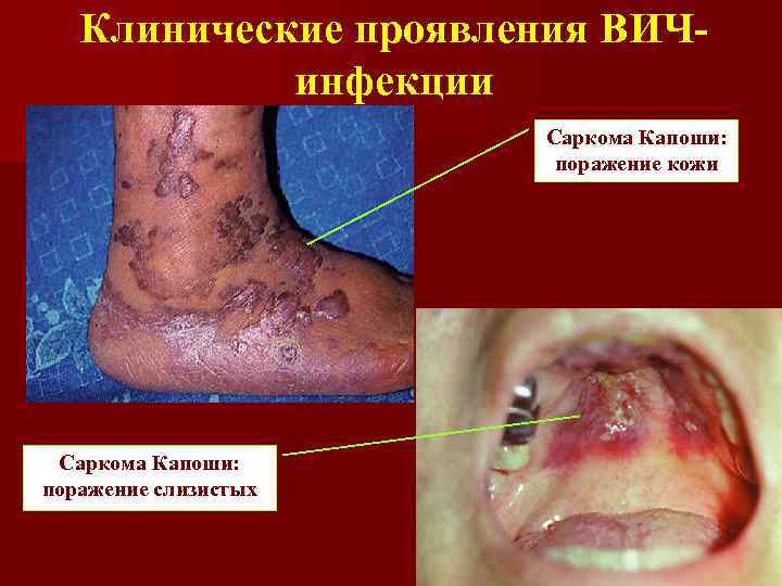 Клинические проявления ВИЧинфекции Саркома Капоши: поражение кожи Саркома Капоши: поражение слизистых 