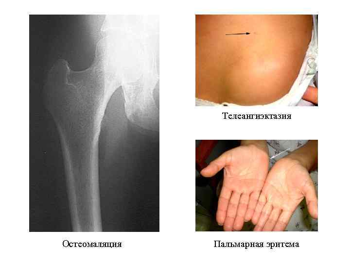     Телеангиэктазия Остеомаляция  Пальмарная эритема 