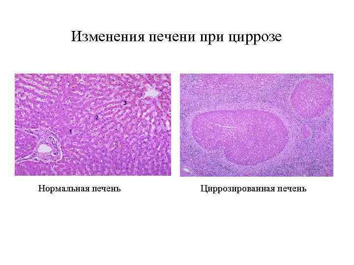  Изменения печени при циррозе Нормальная печень Циррозированная печень 