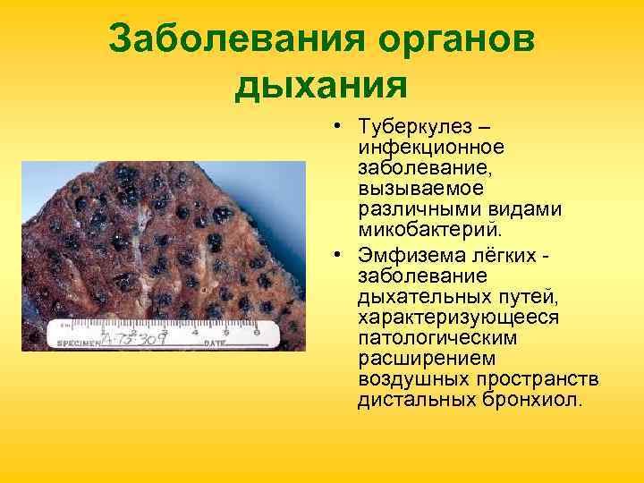 Заболевания органов дыхания • Туберкулез – инфекционное заболевание, Заболевания органов дыхания • Туберкулез – инфекционное заболевание,