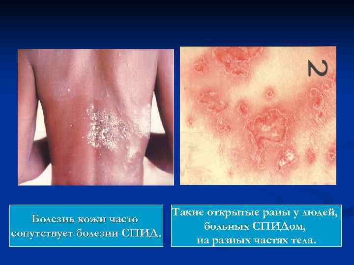      Такие открытые раны у людей, Болезнь кожи часто 