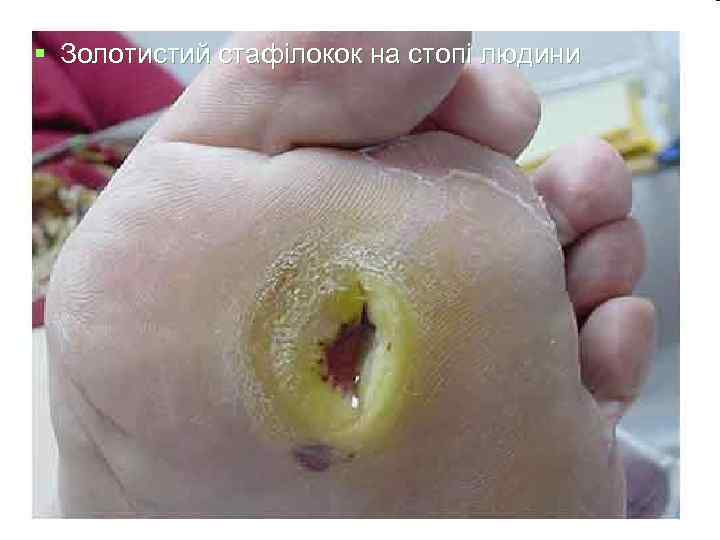 § Золотистий стафілокок на стопі людини 