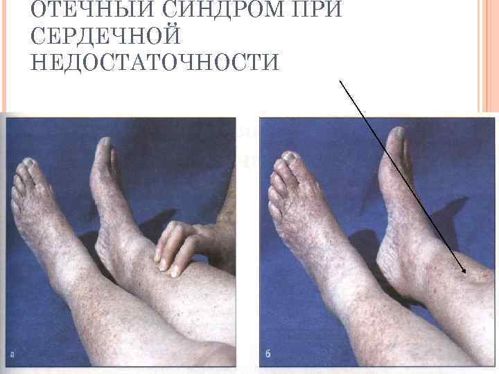 ОТЕЧНЫЙ СИНДРОМ ПРИ СЕРДЕЧНОЙ НЕДОСТАТОЧНОСТИ 