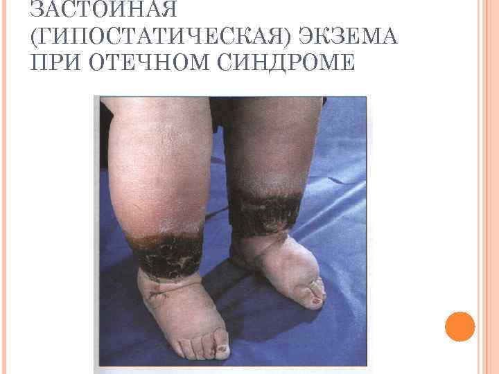 ЗАСТОЙНАЯ (ГИПОСТАТИЧЕСКАЯ) ЭКЗЕМА ПРИ ОТЕЧНОМ СИНДРОМЕ 