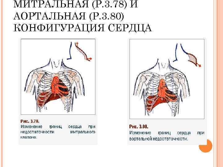 Аортальная конфигурация сердца