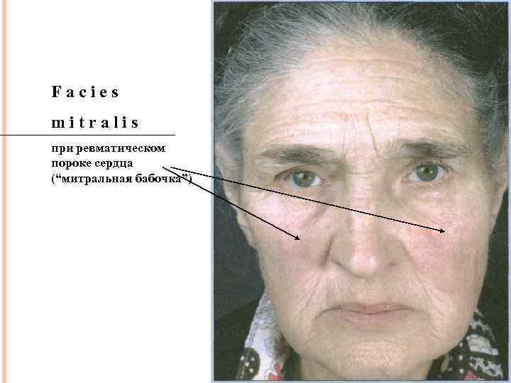 Facies mitralis при ревматическом пороке сердца (“митральная бабочка”) 