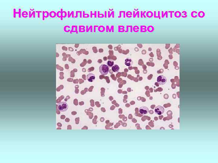 Нейтрофильный лейкоцитоз влево. Лейкоцитоз с нейтрофильным сдвигом. Нейтрофильный лейкоцитоз со сдвигом лейкоцитарной формулы. Лейкоцитоз палочкоядерный сдвиг. Лейкоцитарный сдвиг . Лейкоцитоз.