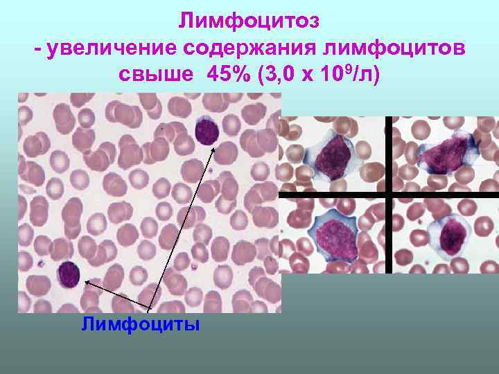 Лимфоцитоз. Гемоцитоз. Лейкоцитоз с абсолютным лимфоцитозом. Незначительный лимфоцитоз.