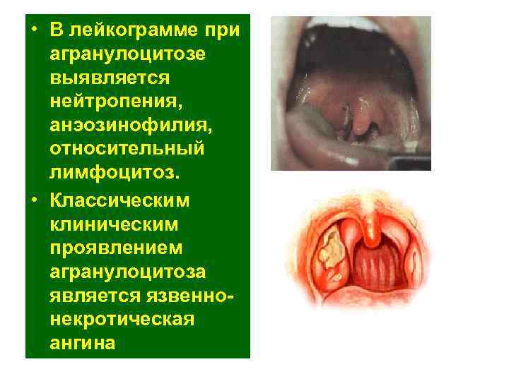 • В лейкограмме при агранулоцитозе выявляется нейтропения, анэозинофилия, • В лейкограмме при агранулоцитозе выявляется нейтропения, анэозинофилия,