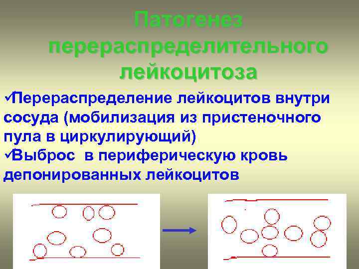 Патогенез перераспределительного лейкоцитоза üПерераспределение лейкоцитов внутри сосуда (мобилизация из пристеночного пула Патогенез перераспределительного лейкоцитоза üПерераспределение лейкоцитов внутри сосуда (мобилизация из пристеночного пула