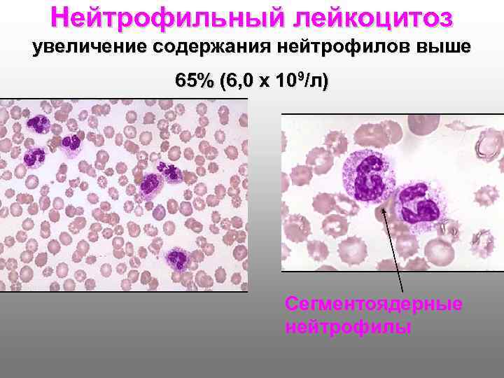 Лейкоцитоз нейтрофилез. Картина крови при нейтрофильном лейкоцитозе. Лейкоцитоз микроскопия. Нейтрофильный лейкоцитоз кровь. Нейтрофильный лейкоцитоз (нейтрофилез) у детей.