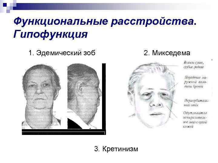 Функциональные расстройства. Гипофункция  1. Эдемический зоб   2. Микседема   