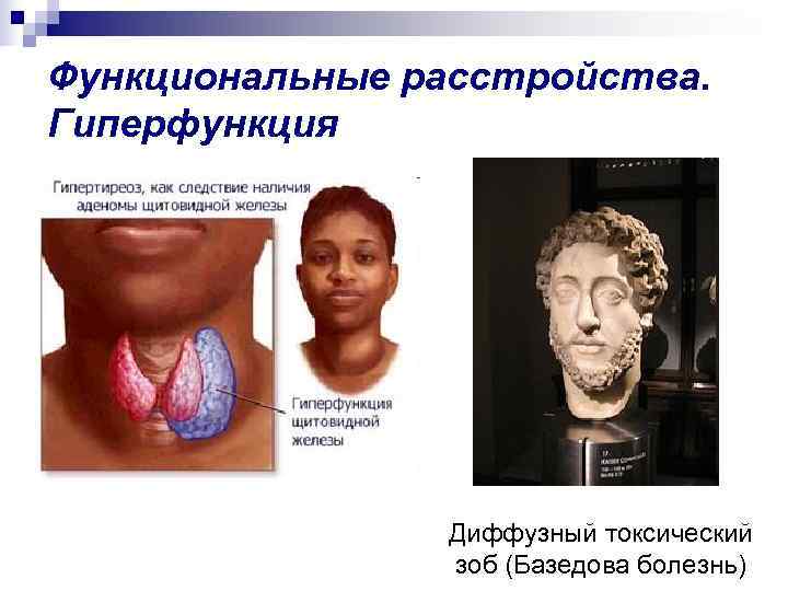 Функциональные расстройства. Гиперфункция     Диффузный токсический   зоб (Базедова болезнь)